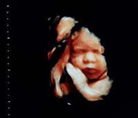 3D baby ultrasound